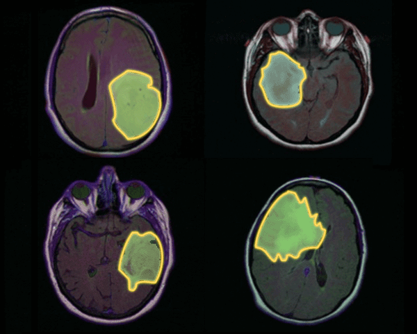 Brain MRI